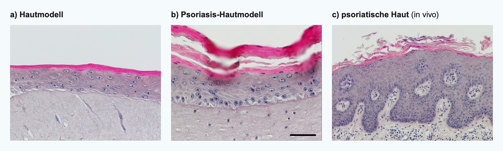 Histologische Schnitte eines Hautmodells gesunder Haut (a) im Vergleich zu unserem 3D-in-vitro-Psoriasismodell (b) und In-vivo-Haut eines Schuppenflechte-Patienten c). Typisch für psoriatische Haut ist die gestörte Differenzierung der Keratinozyten (Parakeratose), die Verdickung der Epidermis (Akanthose) und des stratum corneum (Hyperkeratose). 