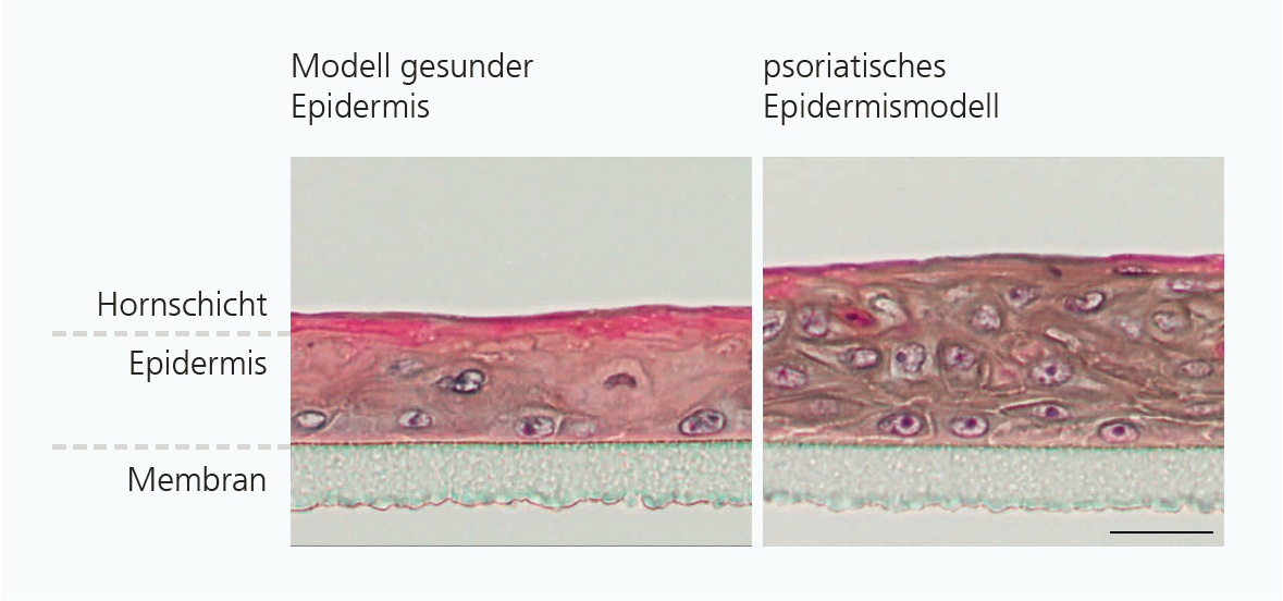 Querschnitt durch ein 3D-In-vitro-Psoriasismodell. Man erkennt die für die Krankheit typische gestörte Verhornung (pink) und Verdickung (Akanthose) der Epidermis. Balken = 25 μm.