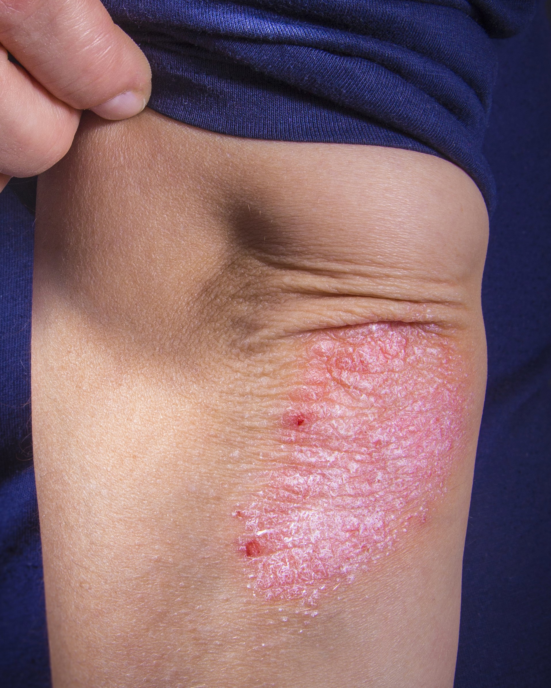 Reddish, inflamed plaques in a psoriasis patient.