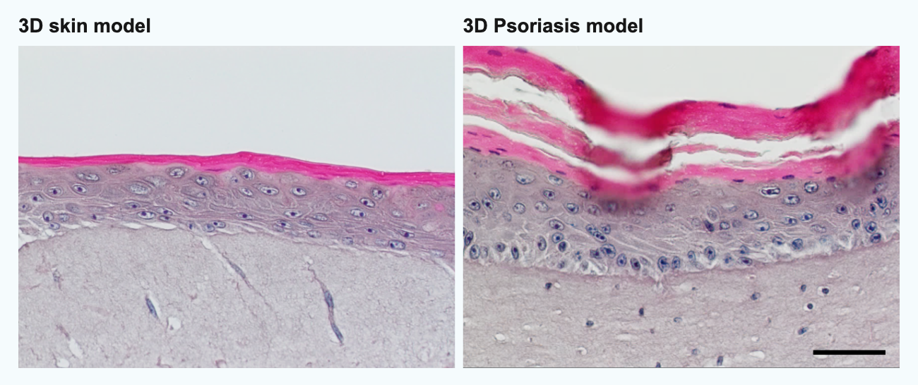 3D in vitro psoriasis model. You can see the typical disordered keratinization (pink) and thickening (acanthosis) of the epidermis. Bar = 75 µm