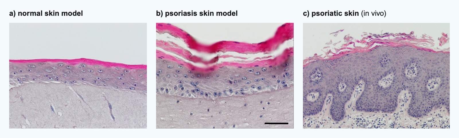 Histological sections of a skin model of healthy skin (a) compared to our 3D in vitro psoriasis model (b) and in vivo skin of a psoriasis patient (c). Disturbed differentiation of keratinocytes (parakeratosis), thickening of the epidermis (acanthosis) and the stratum corneum (hyperkeratosis) are typical of psoriatic skin. 